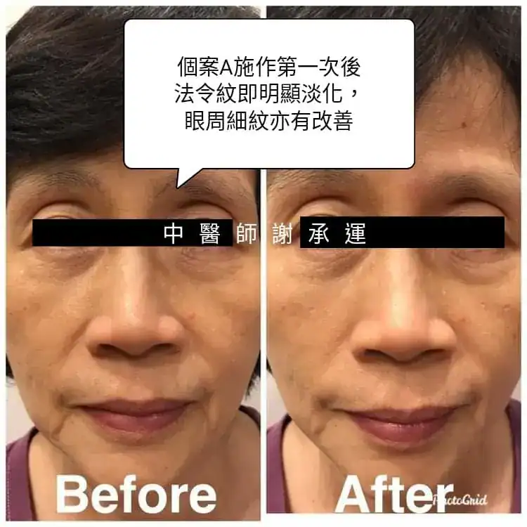 中醫美顏針效果比較－個案A施作第一次後法令紋即明顯淡化，眼周細紋亦有改善