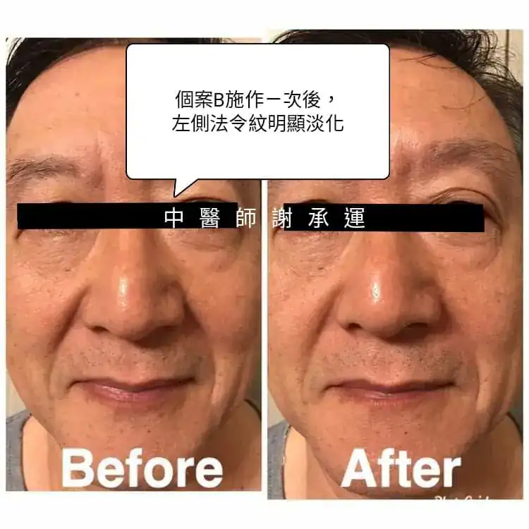 中醫美顏針效果比較－個案B施作一次後， 左側法令紋明顯淡化