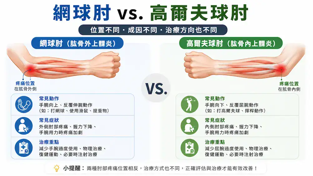 網球肘 vs. 高爾夫球肘 比較資訊